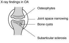 ◾︎ Joint space narrowing
◾︎ Osteophytes
◾︎ Osteosclerosis
◾︎ Cysts