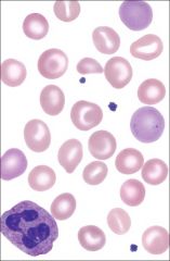 Hereditary xerocytosis
- eccentrocytes (cells with eccentric hemoglobin puddling), stomatocytes, and reticulocytes