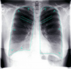 - Lungenemphysem


→ strahlentransparente Lunge


→ Zwerchfelle tief


→ Erweiterte Interkostalräume


- Cor pulmonale


- Exazerbation: pneumonische Infiltrate