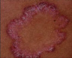 Round, well demarcated/defined edges, raised, central part is clear (i.e. ringworm)
