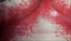 Candida infection, main area of redness & satellite lesions on outskirts (papules or macules)
