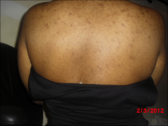 Skin color darker than normal, long hx eczema, INFLAMMATION process changes color of skin