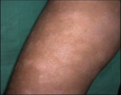 Skin color paler than normal, i.e. fungal rash