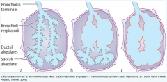 ・Zentrolobulär (Zentroazinär)


- nur proximal zuführende Bronchiloli respiratori d sind erweitert.


- Häufiger


- meist Lungenoberlappen


- im Zusammenhang mit chronischer Bronchitis


 


・Panlobulär (Panazinär)


- G...