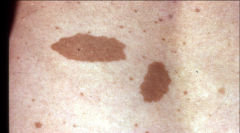 Macule LARGER than 1cm (i.e. senile lentigo/liver spots, mongolian spot, vitiligo, cafe au lait spot)