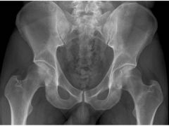 Hx: 20yo M marathoner c/o L sided groin pain x 4 wks, continued to maintain routine running regimen despite the discomfort. xray, bone scan, and MR Fig A-D. What is the next step in management?  1-referral to ortho oncologist; 2-Valgus IT osteotom...