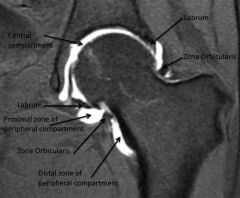 zona orbicularis is the oscopic landmark for access to the iliopsoas. Arthroscopic release of the iliopsoas is performed for tx of an internal snapping hip,caused by the iliopsoas snapping over the iliopectineal eminence or the femoral head, zona ...
