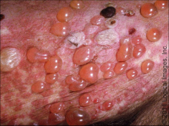 Similar to vesicles but LARGER than 1cm, filled w/ SEROUS FLUID, can be caused by bug bite or bullous pemphigus