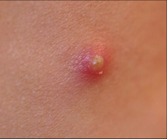 PURULENT VESICLE, filled w/ neutrophils, may be white or yellow, not all pustules are infected (i.e. acne)