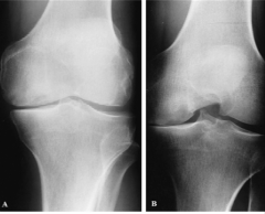 Which of the following xrays views is most sensitive for detecting knee jt OA changes? 1-NWB AP; 2- WB AP; 3- NWB PA in 45 deg flex;4-WB PA in 45 deg flex 5-Merchant