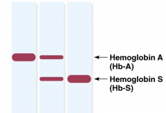 L'anémie falciforme est une maladie moléculaire puisqu'il y a une différence de charge entre les molécules d'hémoglobine A et d'hémoglobine S.

Il y a un changement d'un résidu Glu pour un résidu Val (changement dans un peptide, observé g...