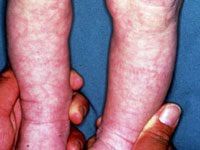 lacy, reticulated vascular pattern over most of body when baby is cooled


improves over first month