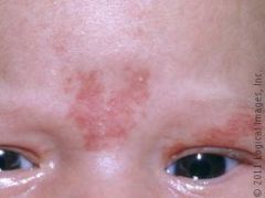 pale, pink vascular macules


found in nuchal area, glabella, eyelids
usually disappears