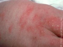 firm, yellow-white papules/pustules with erythematous base


peaks on second day of life
contain eosinophils
benign