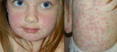 Rash that looks like measles

Consists of macular lesions that are red & usually 2–10 mm in diameter but may be confluent in places.
