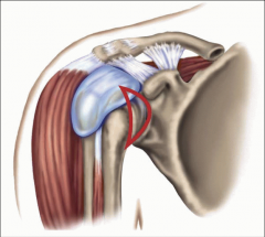 - fibrosis of the glenohumeral joint capsule 
- manifested by diffuse, dull, aching pain in the shoulder and progressive restriction of active and passive range of motion
 
- usually no localized tenderness
 
-usually unilateral and occurs in peop...