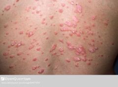 PAPULAR rash, bumpy, scales
Presents w/ both papules & scales, or both scaly papules & plaques