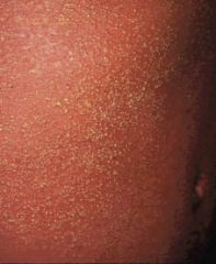 Scarlet fever rashes, papular sand paper type rash, usually on TRUNK