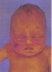 Feto de 8 semanas de formación es abortado, en la necropsia se evidencia presencia de lesiones pustulosas, granulomas múltiples, y secuelas de septicemia, ¿Agente causal más probable? 