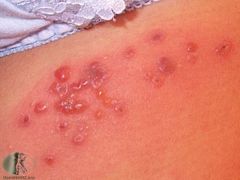 Looks like a herpes infection, with grouped umbilicated vesicles.