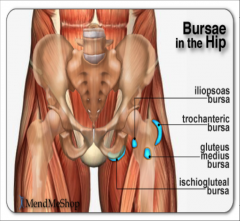 - bursitis is an inflammation or degeneration of the sac- like structure that protect the soft tissue from underlying bony prominences 
- pain with movement and rest 
-swelling 
- locaized tenderness over the site of inflammation 
- if effusion pr...