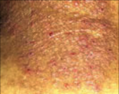 Caused by chronic rubbing/scratching, which results in palpably thickened skin w/ increased skin markings & lichenoid scale

i.e. chronic atopic eczema & lichen simplex
