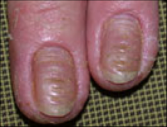 Degeneration or abnormal formation of the skin. It is often used to refer to nail diseases.