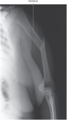 A woman riding a mountain bike on a rough trail hits a rut and is thrown from the bike. Her upper arm hits a tree, fracturing the humerus just above the insertion of the teres major muscle. Later, during examination, it is noted that she cannot ex...