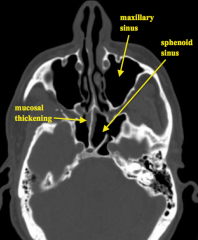 - Maxillary sinuses (at top of image)
- Sphenoid sinuses (posterior / below maxillary sinuses in image)