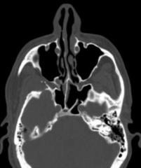 What sinuses can be viewed in this axial section?