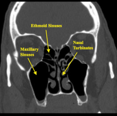 - Ethmoid Sinuses (in between orbits)
- Maxillary Sinuses (below orbits)