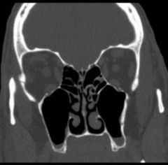 What sinuses can be viewed in this coronal section?
