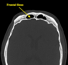 Frontal Sinuses