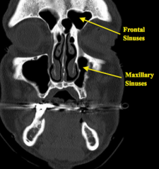 - Frontal Sinuses
- Maxillary Sinuses