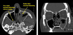 Acute Sinusitis (probably did not require imaging and could have been treated based on clinical grounds)

- Really thick mucosal thickening on L maxillary sinus
- Small mucosal thickening in R maxillary sinus with an air bubble trapped in the s...