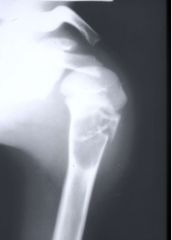 Décrire la modification de densité osseuse et la patho