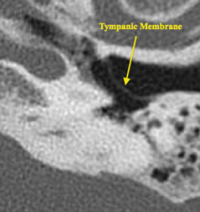 Tympanic membrane