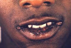 assoc with syphilis
thickening and fissures of corners of mouth
