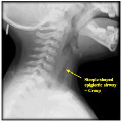 Croup = Steeple Sign on lateral X-ray
- Kids have "barking cough"