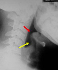 Epiglottitis:
- Inflammation of the epiglottis 
- Looks like thumb print instead of a thin structure
- Not seen very commonly anymore d/t Haemophilus vaccine
- Emergency situation and may require tracheotomy to breathe