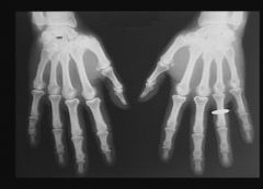 Femme de 55 ans.
Depuis 8 ans douleurs modérées des articulations inter-phalangiennes proximales et distales des doigts, avec aspect modérément inflammatoire. Il y a une tuméfaction dure en regard des IPP avec déformation de l'index. Par ai...