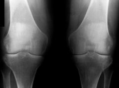 Polyarthrite rhumatoïde séropositive connue chez une patiente de 60 ans. 
Y a t-il une atteinte dans le cadre de cette maladie inflammatoire, des genoux ?