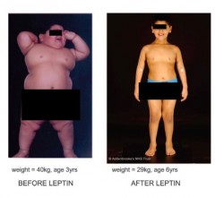 - Without leptin will become obese (not getting any feedback that you have enough fat stores, so you keep storing fat)
- With leptin will maintain a normal weight (tells your body you have enough fat tissue)