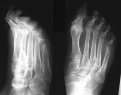 Patient de 73 ans, diabétique avec complications multiples, présentant un mal perforant plantaire du pied droit, en regard de la MP du 5ème espace.
