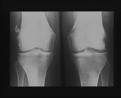 Femme de 63 ans.
Tuméfaction inflammatoire de son genou droit. 

ATCD de douleurs à la marche et à la descente des escaliers des deux genoux depuis de nombreuses années.