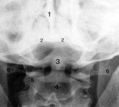 Radiographie du rachis cervical de face, centrée sur C1 – C2, bouche ouverte.