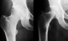Comparaison de densité d’une hanche normale et d’une hanche ostéoporotique