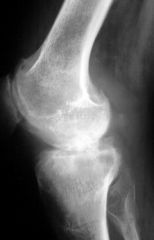 Douleurs mécaniques des 2 genoux à prédominance droite chez un patient de 27 ans connue pour une hémophilie A.