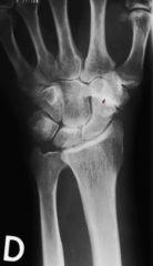 Douleurs mécaniques majorées par la mobilisation du poignet et de la main.