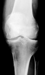 De ces 2 genoux, lequel souffre de PR et lequel souffre d’arthrose ?